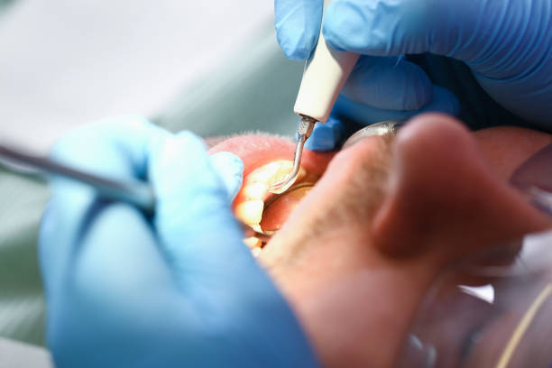 Best Emergency Wisdom Teeth Removal in North Corbin, KY